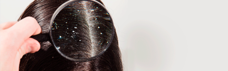 O que é bom para a caspa?