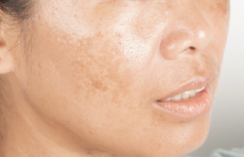 Pele oleosa: Aprenda como cuidar