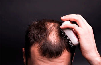 O que é alopecia? O que causa a alopecia?